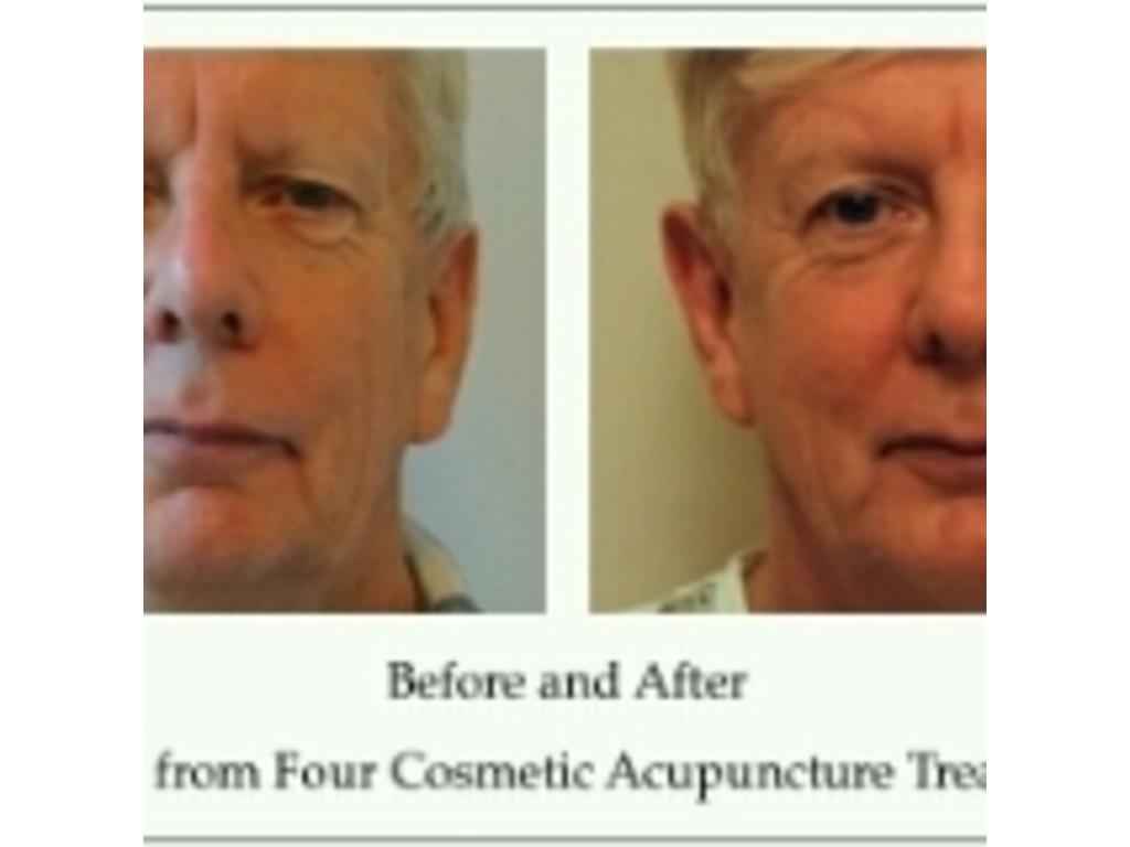 Acupuncture treatment in North Shields Pamperdeck